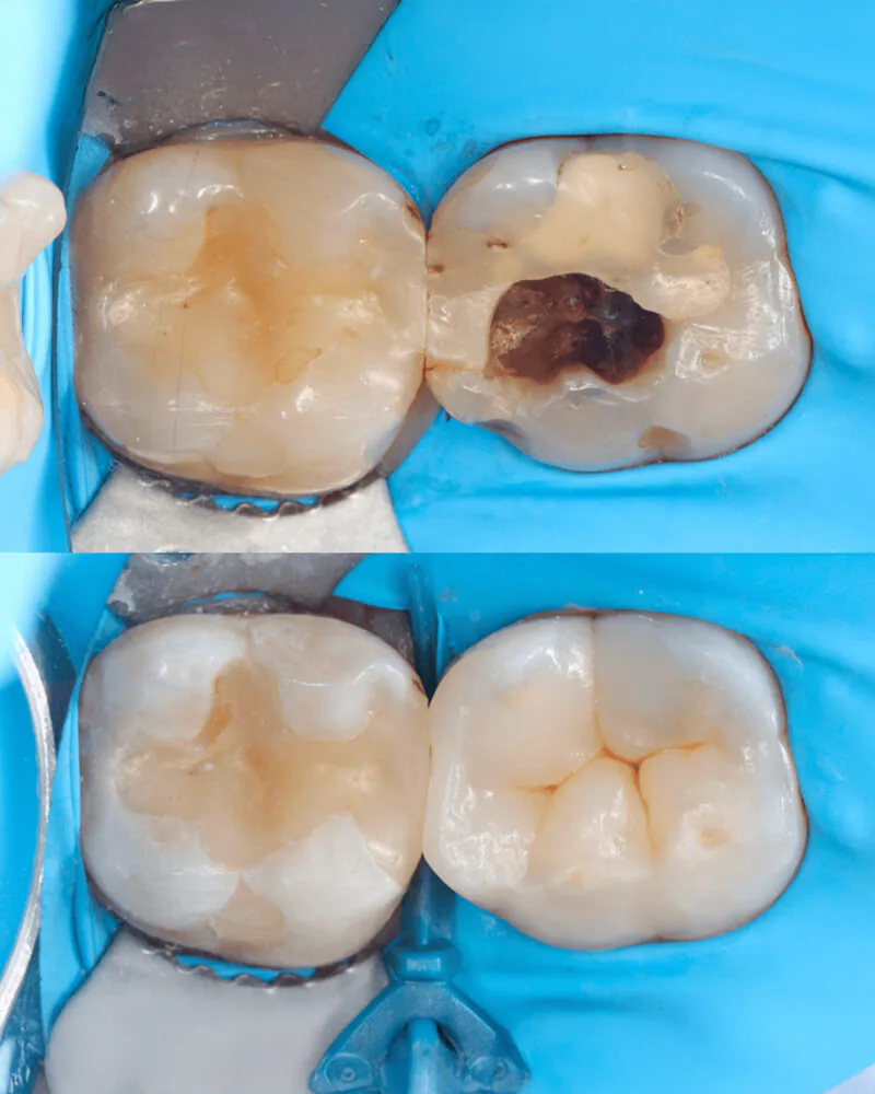 Replacement of a composite filling over deep tooth decay, before and after