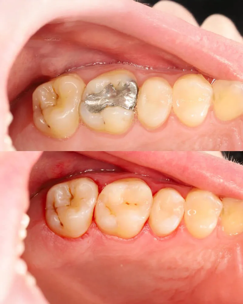Amalgam filling replaced with a composite filling, before and after