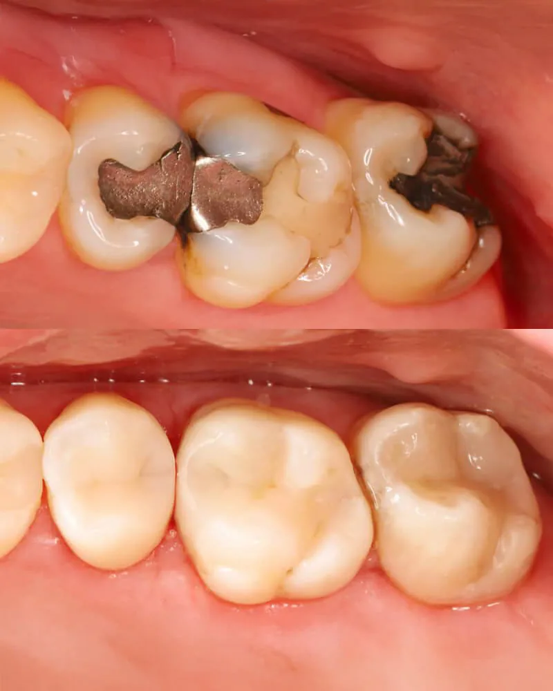 Replacement of amalgam fillings on several teeth, before and after
